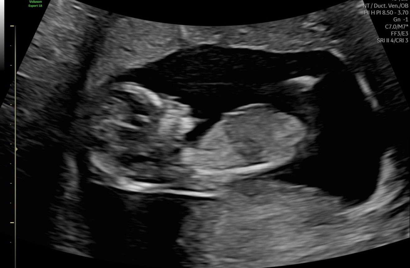 Ultrasound photo