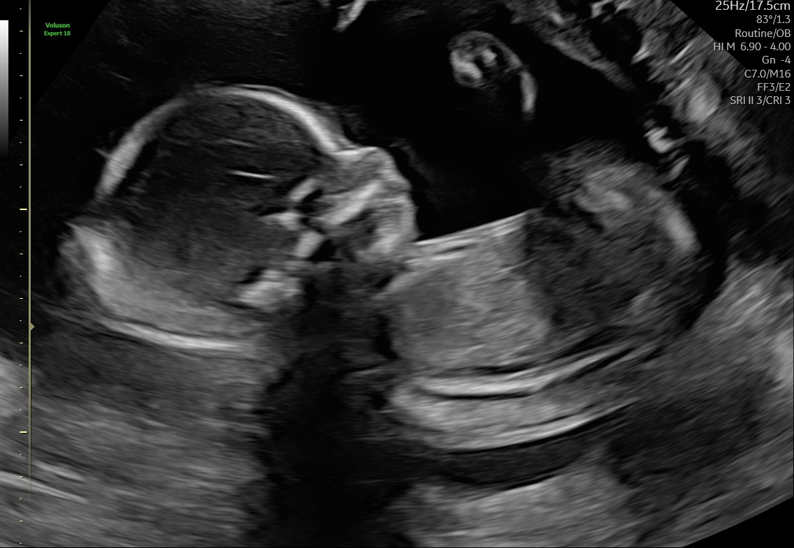 Ultrasound photo 2